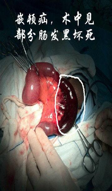 成人推疝气的手法视频-第1张图片-同人3d动漫 成人推疝气的手法视频-第1张图片-同人3d动漫