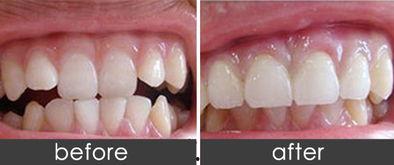 成人矫正隐适美牙齿视频,见证微笑蜕变之旅-第2张图片-同人3d动漫