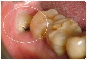 成人龋齿拔牙视频过程图,成人龋齿拔牙全过程图解-第2张图片-同人3d动漫