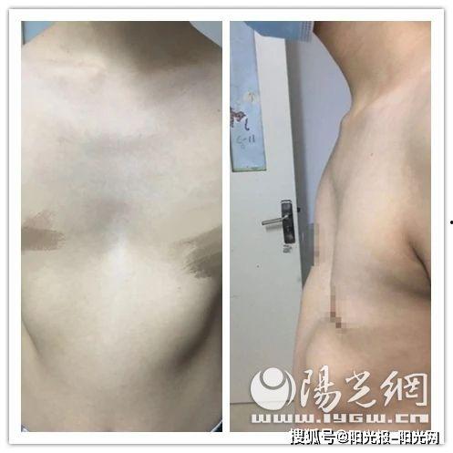 成人胸外凸怎么矫正视频,轻松掌握矫正方法-第3张图片-同人3d动漫