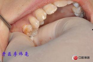 成人门牙拔除视频过程-第1张图片-同人3d动漫