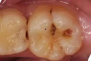 成人门牙拔除视频过程-第3张图片-同人3d动漫